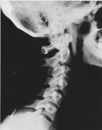 spine xray