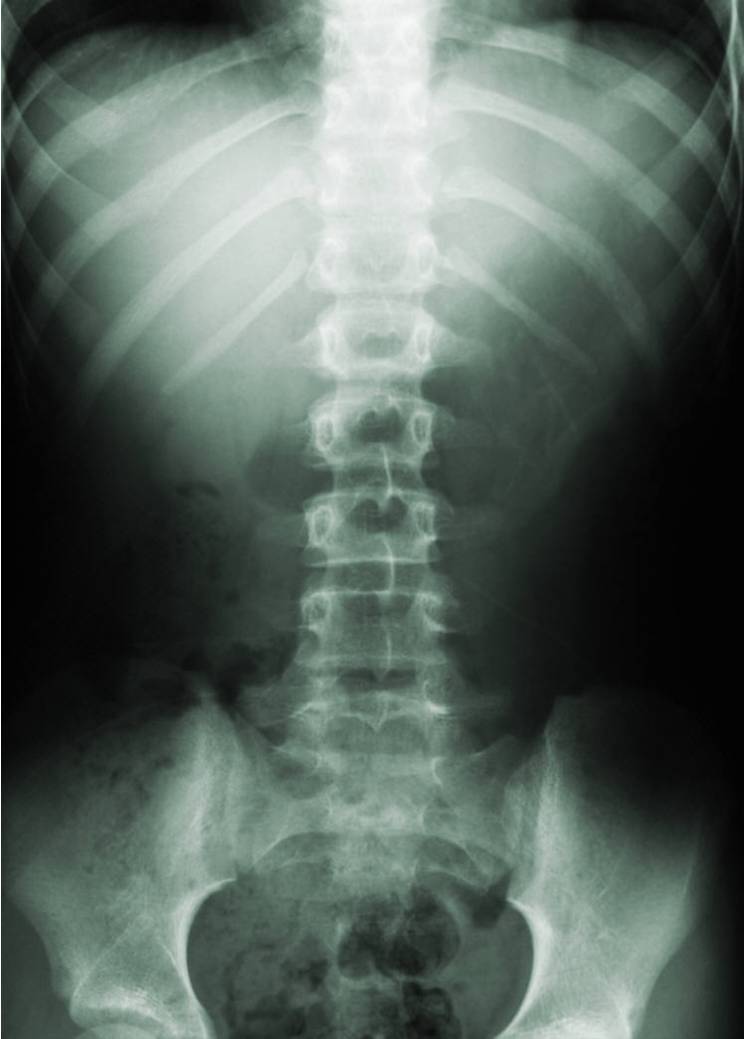 Spine X-Ray