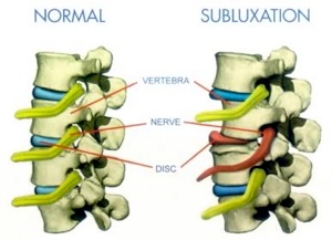 Subluxation